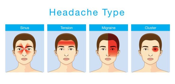 סוגי כאבי הראש העיקריים