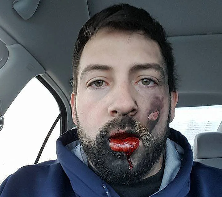 מיד לאחר הפציעה