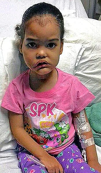 מליסה לאחר הניתוח