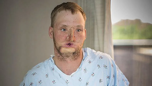 אנדי סנדרס לפני השתלת הפנים