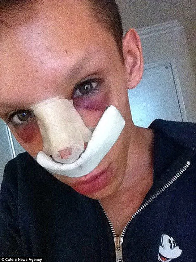 ויני בתחילת התהליך. אחרי ניתוח אף