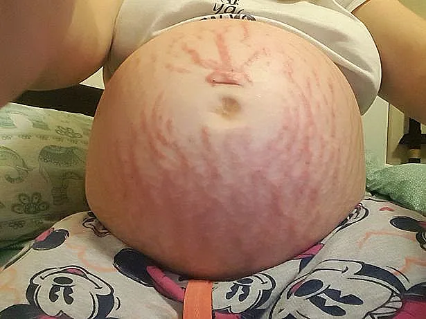 פריחה קשה ממנה סבלה במהלך ההריון