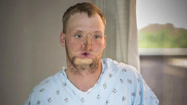 אנדי סנדרס לפני השתלת הפנים