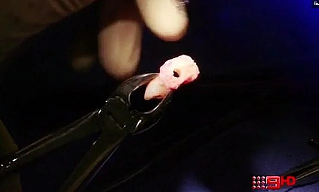 השן של ג'ון שסייעה להחזיר את ראייתו