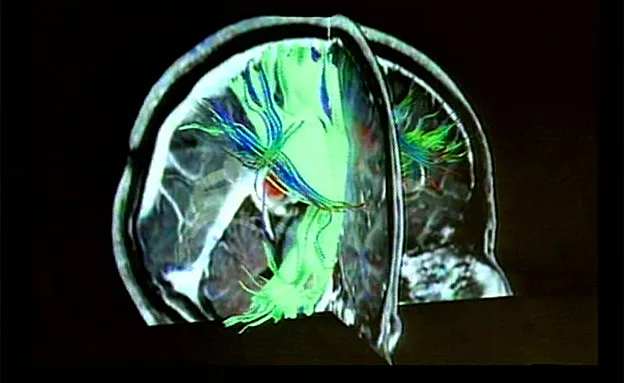 ''משחק על מוקדים עצביים''