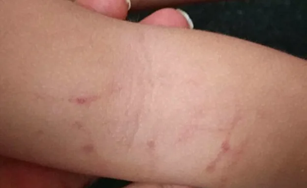 רופא קבע - מדובר בסימני אחיזה ברורים