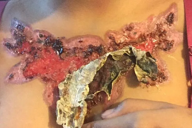 עם הזמן העור מתקלף יותר ויותר