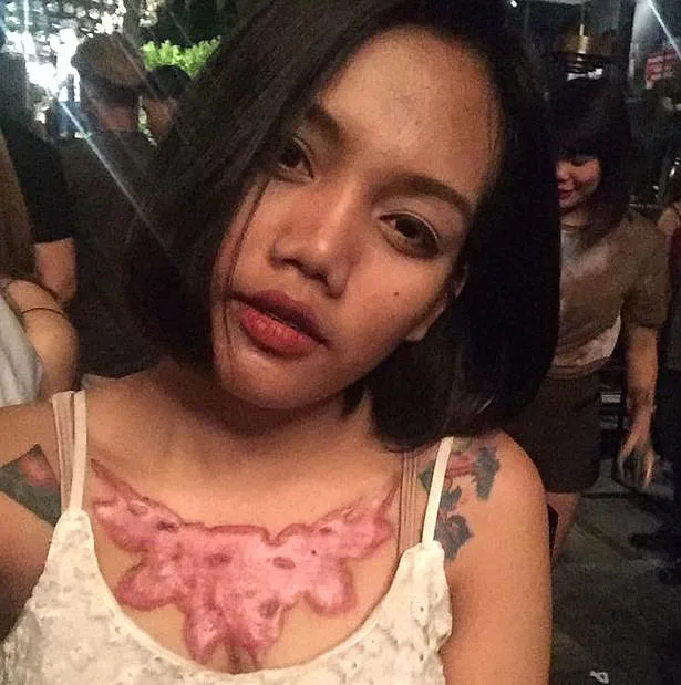 הצלקת שנשארה לפאסודה על החזה