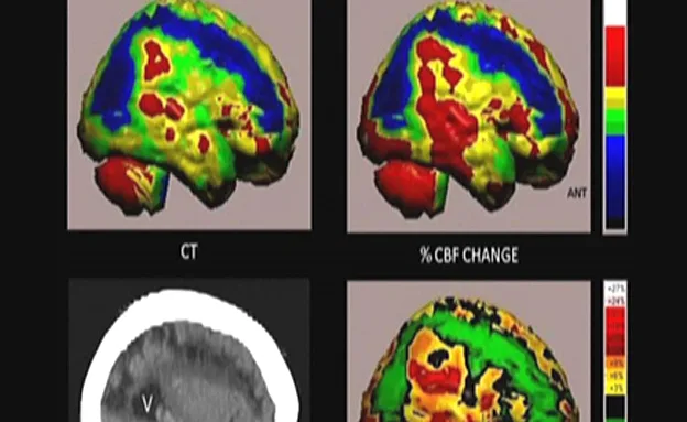הטיפול מתקן נזקים משבץ מוחי (חדשות 2)