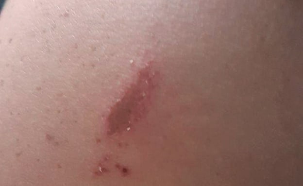 הפצעים על אחד החיילים בבסיס