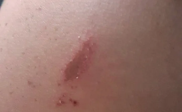 הפצעים שהתגלו על חלק מהחיילים