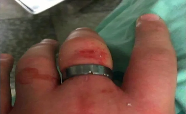 תאונת הספינר של הנער מראשל''צ