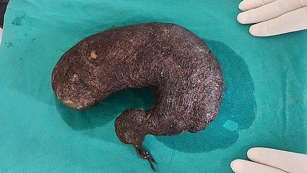 כדור השיער שהוצא מבטנה של הנערה