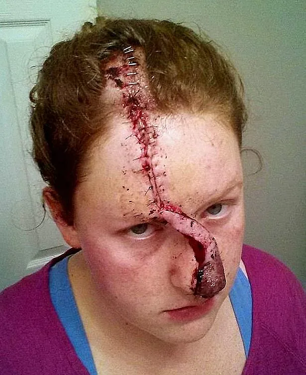 לאחר כ-30 ניתוחים - שחזור האף