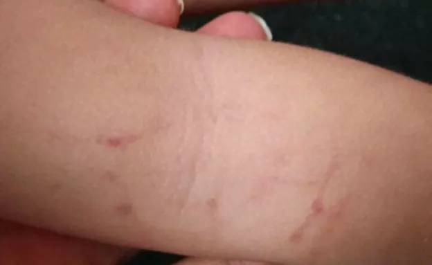 רופא קבע - מדובר בסימני אחיזה ברורים