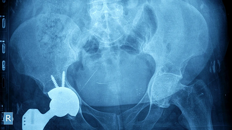 צילום רנטגן של מפרק ירך