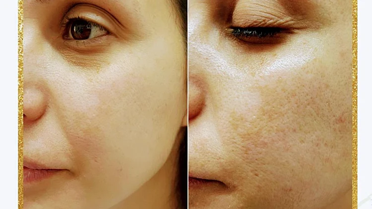 תמונה לפני ואחרי טיפול פנים אצל תניה יוסופוב
