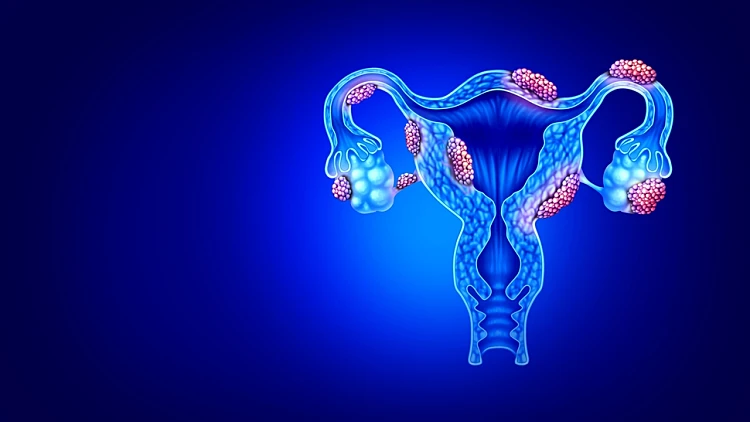 Endometriosis,disease,anatomy,concept,of,female,infertility,condition,as,uterus