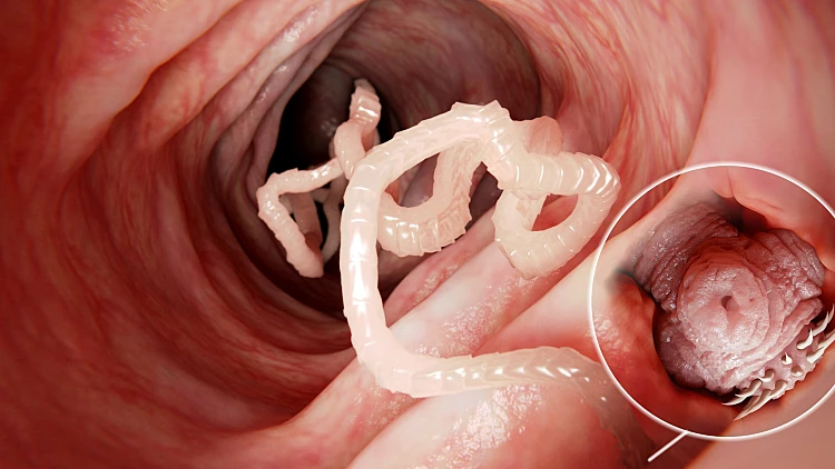 Tapeworm,in,human,intestine,,magnification,of,the,head,attached,to