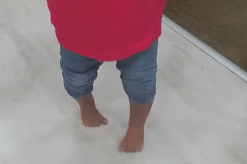 כפות רגליו של פעוט שסובל מסטייה בכפות הרגליים - ממטרזוס אדוקטוס