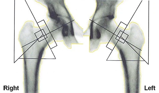 השפעת קרינה סלולרית על עצמות האגן