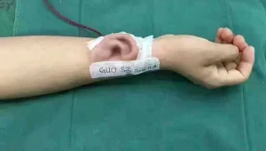 תקשיבו: המטופל איבד את אוזנו בתאונה - הרופאים גידלו לו אוזן על היד