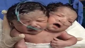 תינוק נולד עם שני ראשים שבוכים באותו הזמן