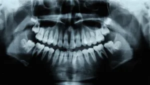 שן תחת שן: 526 שיניים הוצאו מפיו של ילד בן 7