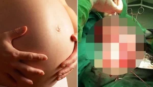 אישה בהיריון נחרדה לגלות: זה היה גידול