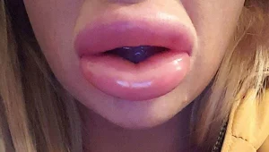 רצתה להגדיל את השפתיים וזה מה שקרה לה