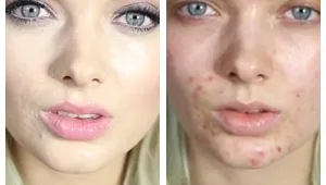 לפני ואחרי: מעור מחוצ'קן לפרצוף מושלם - הבלוגרית האמיצה שתלמד אתכן איך לעשות את זה בעצמכן