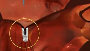 פתרון חדש לחולי לב: ניתוח שלא מצריך ניתוח לב פתוח