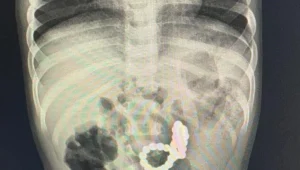 צילום הרנטגן גילה: מחרוזת בגופו של פעוט כבן שנה