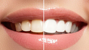 טיפים לשיניים לבנות ולהלבנת שיניים צהובות