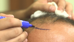 הרופאים שלומדים להשתיל שיער - כדי להשאיר את הלקוחות הישראלים בארץ