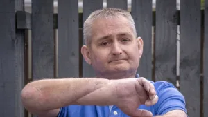 "קיבלתי חיים חדשים": בן 48 מאירלנד עבר השתלת ידיים