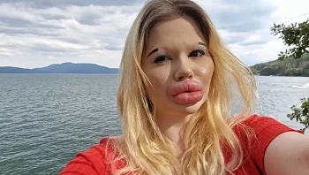 האישה עם השפתיים הכי גדולות בעולם: "כואב לי, קשה לי לחייך"
