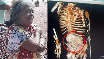 אישה בת 81 עברה ניתוח להסרת עובר מאובן ששהה בבטנה 56 שנה