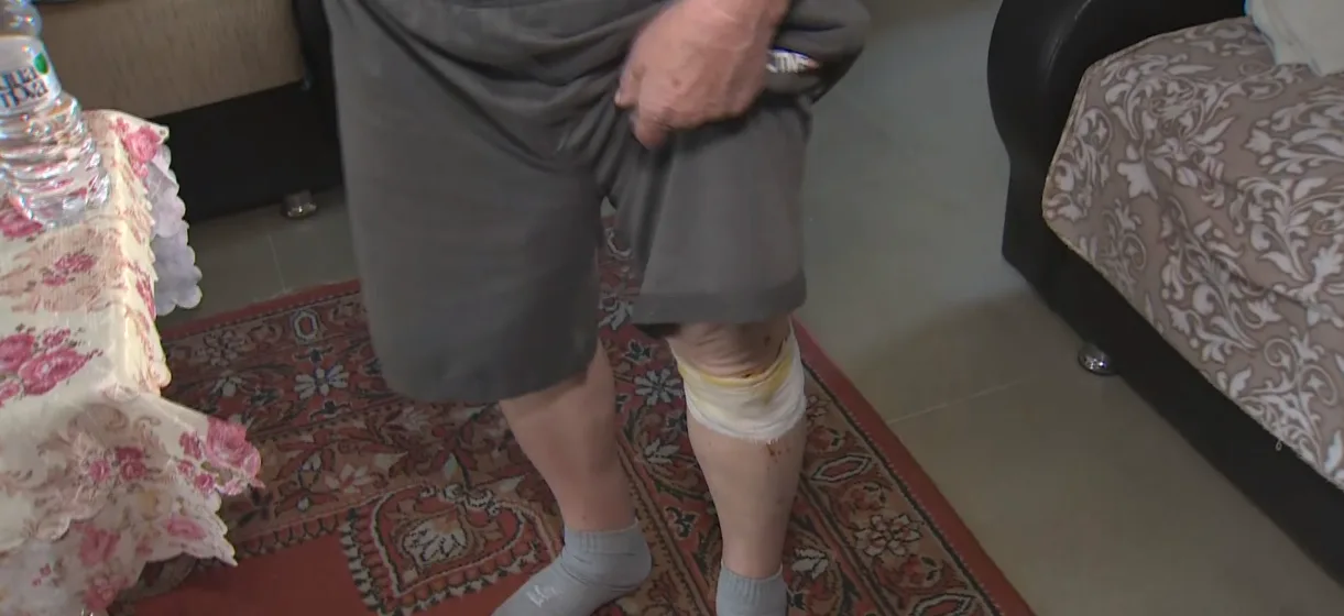 רגלו הפצועה של יוסף קומסרצ'יק שהותקף על ידי שכנו